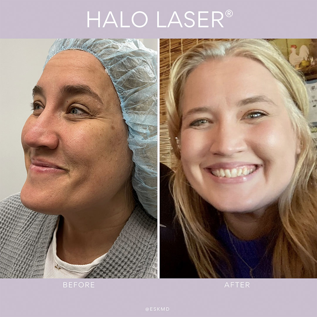 Halo Laser Resurfacing NYC Halo Laser Treatment New York
