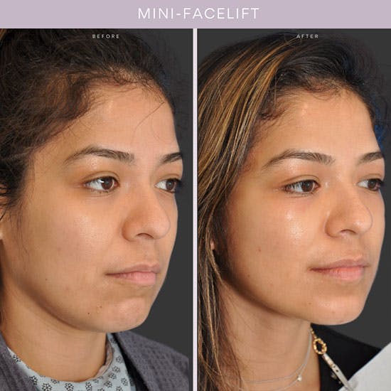 Facelift NYC  Mini Facelift & Traditional Facelift Surgery