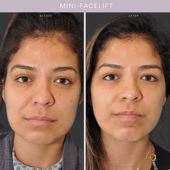 Facelift Nyc | Mini Facelift & Traditional Facelift Surgery